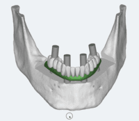 Screenshot of 3D view for a dental LightningCAD application